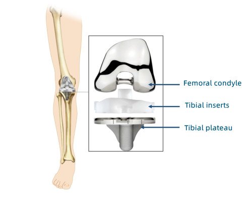 Femoral condyle